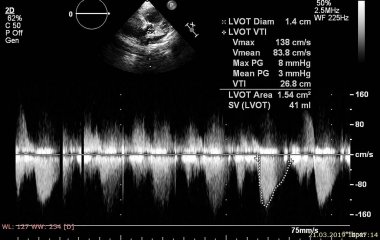Ekokardiyografi (ultrason) makinesi nin ekranı.