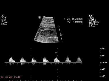 Fetal kalbin ultrason muayenesi