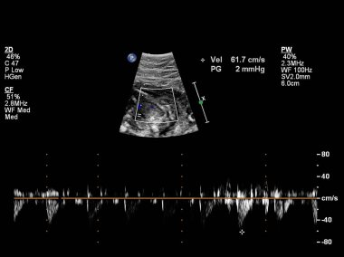 Fetal kalbin ultrason muayenesi