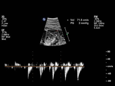 Fetal kalbin ultrason muayenesi