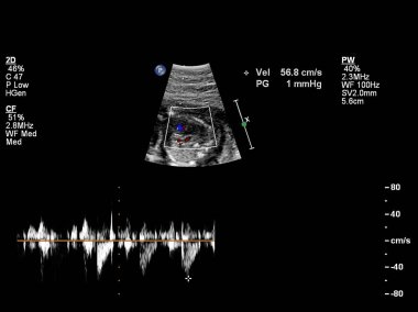 Fetal kalbin ultrason muayenesi