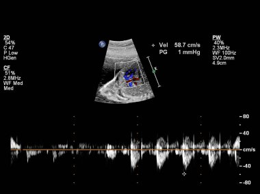 Fetal kalbin ultrason muayenesi