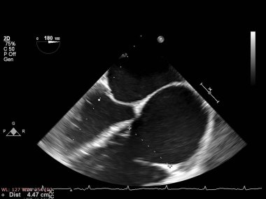 Screen of echocardiography (ultrasound) machine. clipart