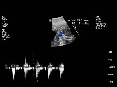 Fetal kalbin ultrason muayenesi.