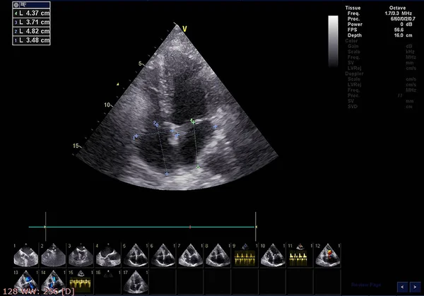 Screen of echocardiography (ultrasound) machine. — Stock Photo, Image