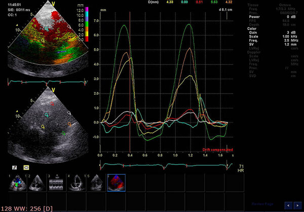 Screen of echocardiography (ultrasound) machine.