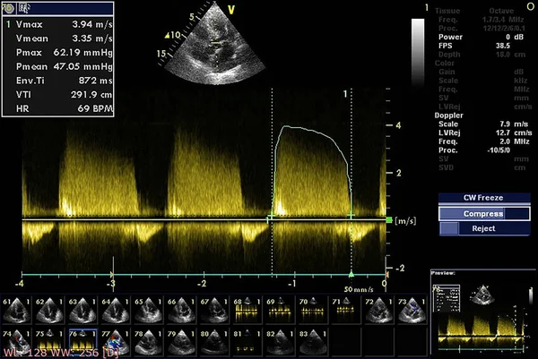 Scherm van echocardiografie (echografie) machine. — Stockfoto