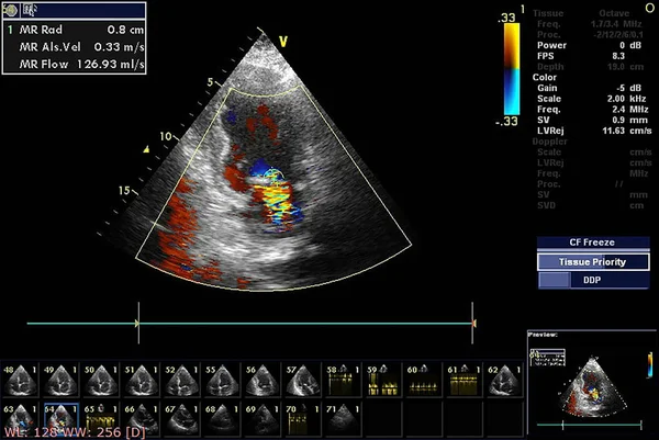 Экран эхокардиографической (ультразвуковой) машины . — стоковое фото
