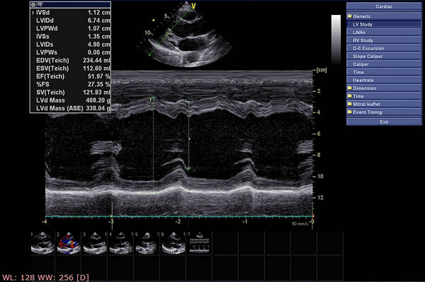 Экран эхокардиографической (ультразвуковой) машины
.