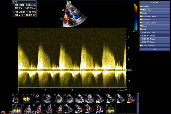 Screen of echocardiography (ultrasound) machine.