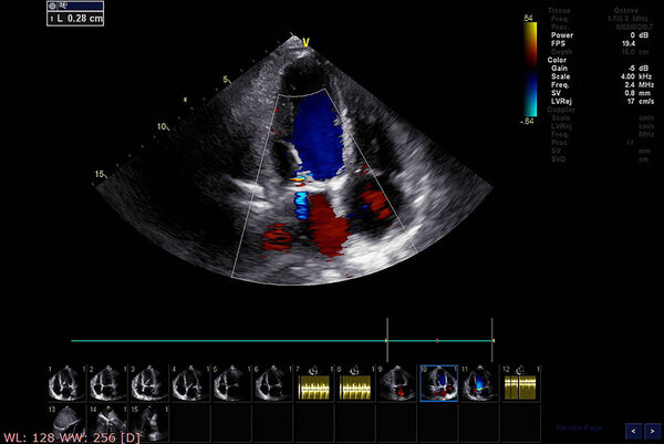 Экран эхокардиографической (ультразвуковой) машины
.