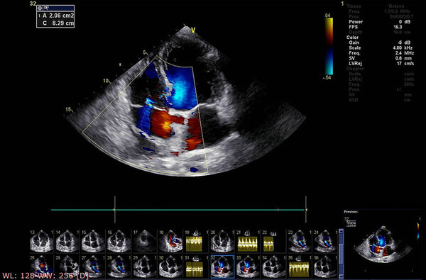 Screen of echocardiography (ultrasound) machine.