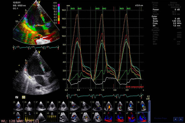Screen of echocardiography (ultrasound) machine.