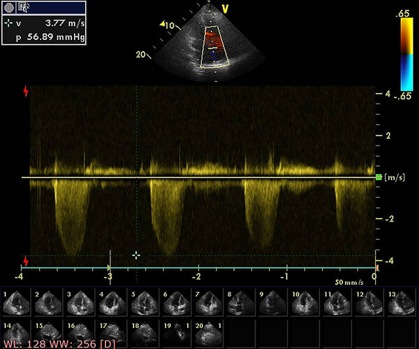 Screen of echocardiography (ultrasound) machine.