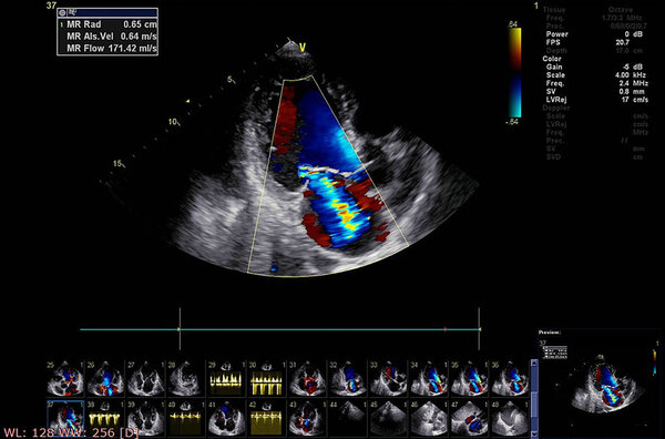 Экран эхокардиографической (ультразвуковой) машины
.