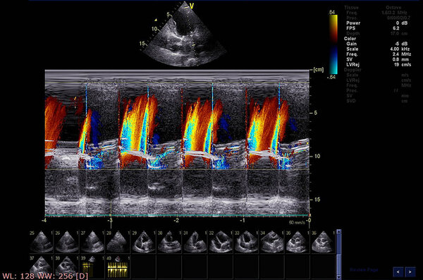 Screen of echocardiography (ultrasound) machine.