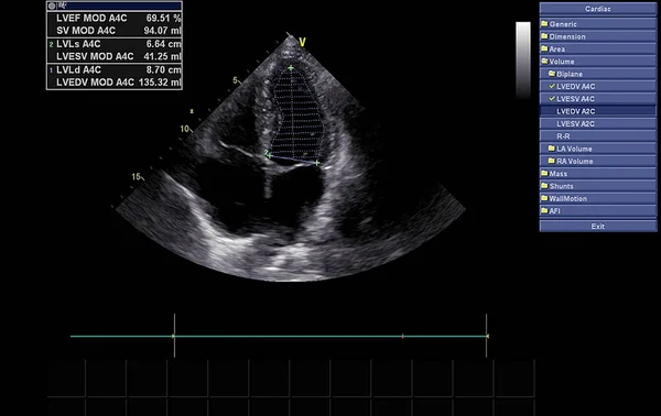 Screen of echocardiography (ultrasound) machine. — Stock Photo, Image