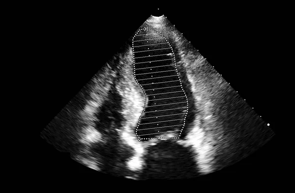 Screen of echocardiography (ultrasound) machine. — Stock Photo, Image