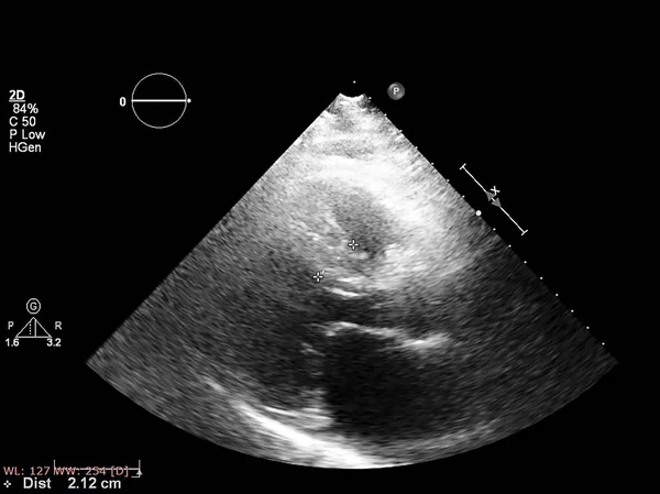 Οθόνη ηχοκαρδιογραφίας (υπερήχων) μηχανή. — Φωτογραφία Αρχείου