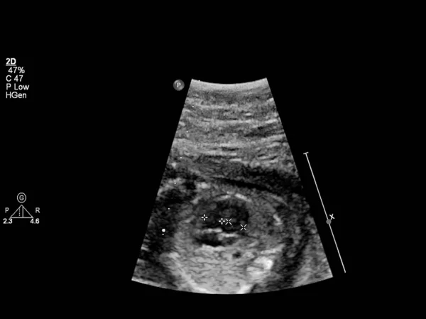 Ultrasound examination of the fetal heart — Stock Photo, Image