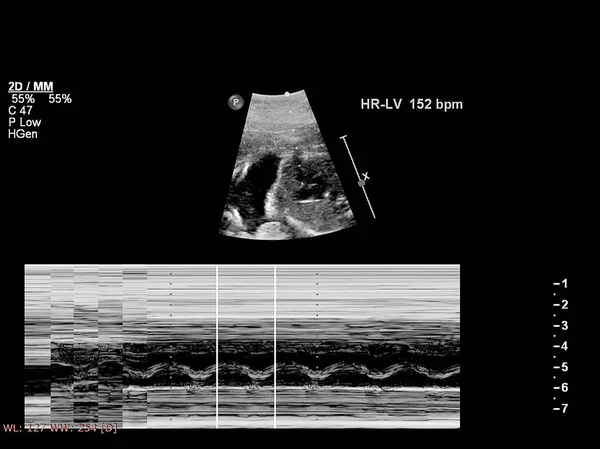 Badanie ultrasonograficzne serca płodu — Zdjęcie stockowe