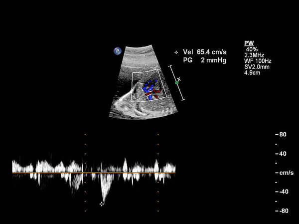 УЗИ сердца плода
.