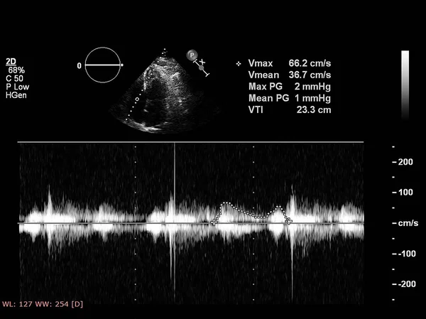 Obrazovka počítače s echokardiografií (ultrazvukem). — Stock fotografie