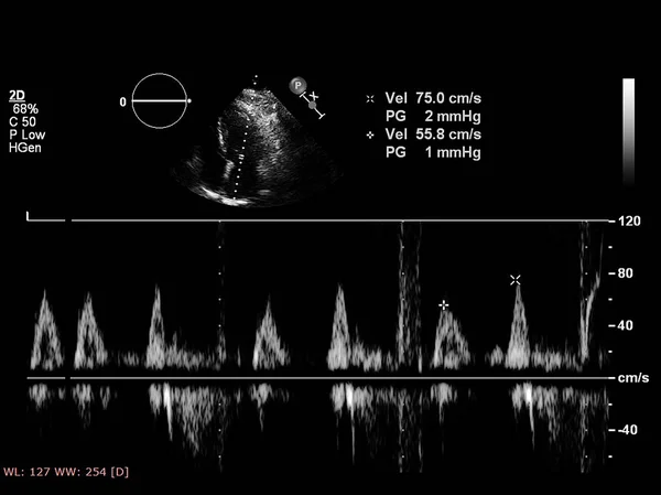 Ekran echokardiografii (USG) maszyny. — Zdjęcie stockowe