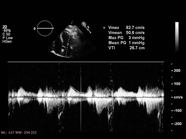 Tela da máquina de ecocardiografia (ultra-som) . — Fotografia de Stock