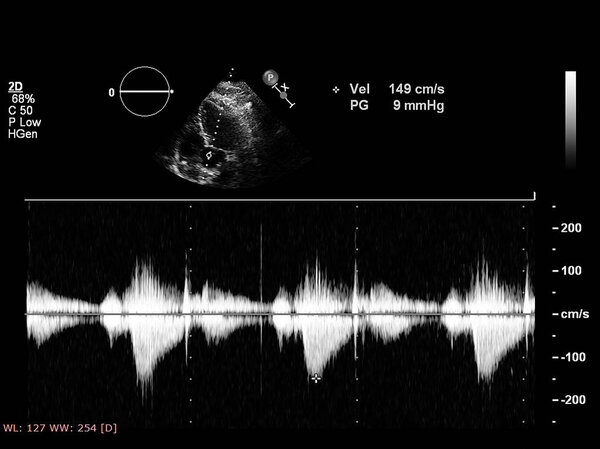 Экран эхокардиографической (ультразвуковой) машины
.