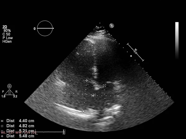 Tela da máquina de ecocardiografia (ultra-som) . — Fotografia de Stock