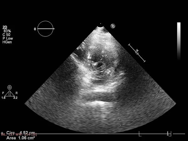 Pantalla de la máquina de ecocardiografía (ultrasonido) . — Foto de Stock