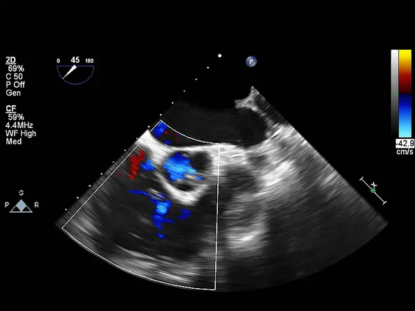 Screen of echocardiography (ultrasound) machine. — Stock Photo, Image