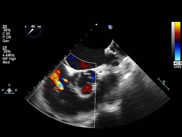 Screen of echocardiography (ultrasound) machine.