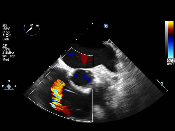 Screen of echocardiography (ultrasound) machine.