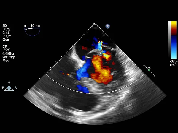 Pantalla de la máquina de ecocardiografía (ultrasonido) . — Foto de Stock