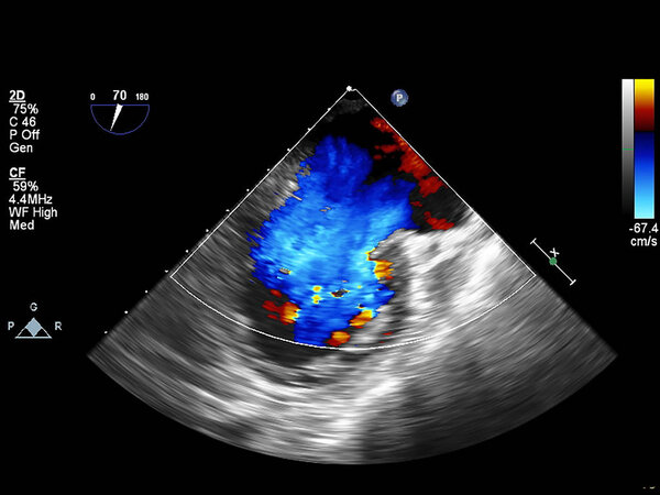 Screen of echocardiography (ultrasound) machine.