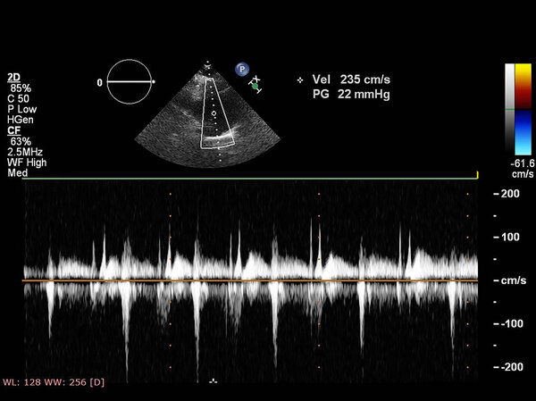 Экран эхокардиографической (ультразвуковой) машины
.