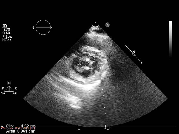 Screen of echocardiography (ultrasound) machine.