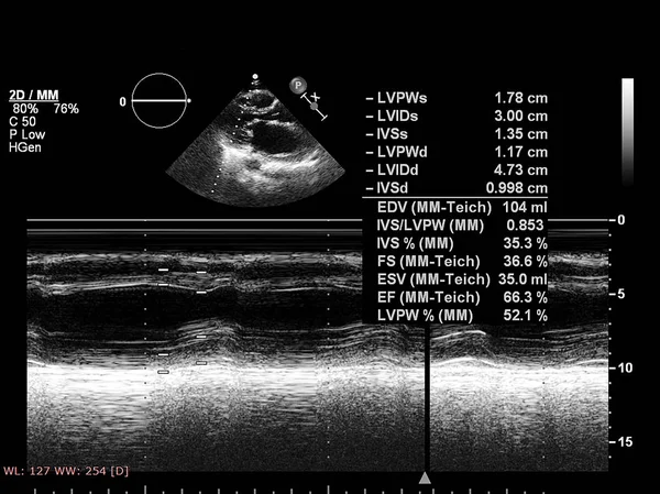 Tela da máquina de ecocardiografia (ultra-som) . — Fotografia de Stock