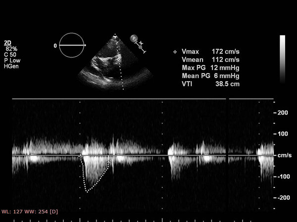 Экран эхокардиографической (ультразвуковой) машины
.