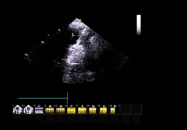 Screen of echocardiography (ultrasound) machine. — Stock Photo, Image