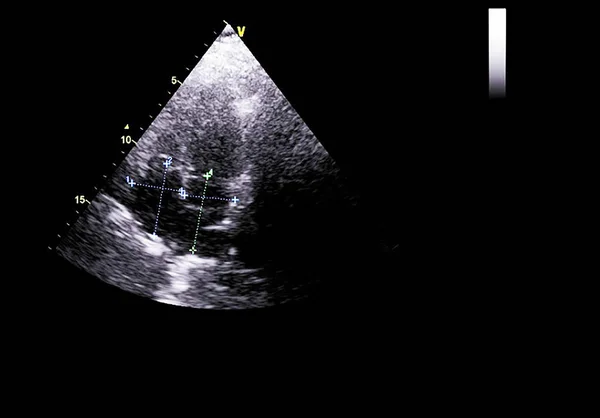 Pantalla de la máquina de ecocardiografía (ultrasonido) . —  Fotos de Stock