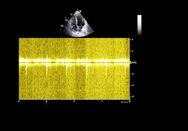 Экран эхокардиографической (ультразвуковой) машины
.