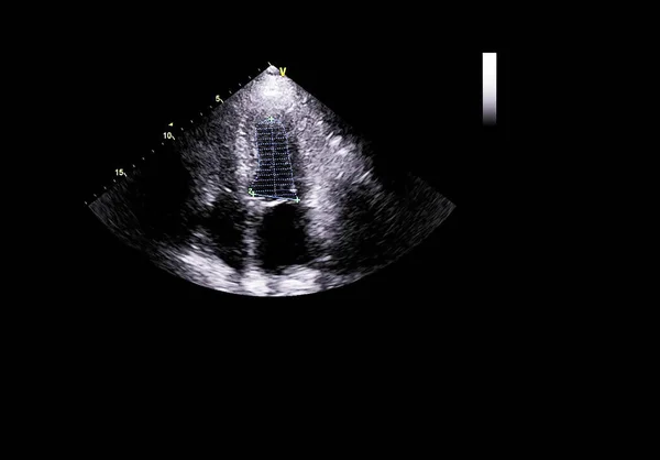 Pantalla de la máquina de ecocardiografía (ultrasonido) . — Foto de Stock