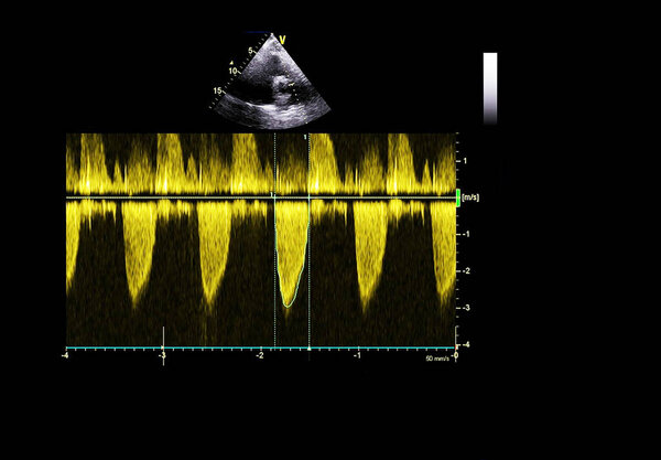 Экран эхокардиографической (ультразвуковой) машины
.