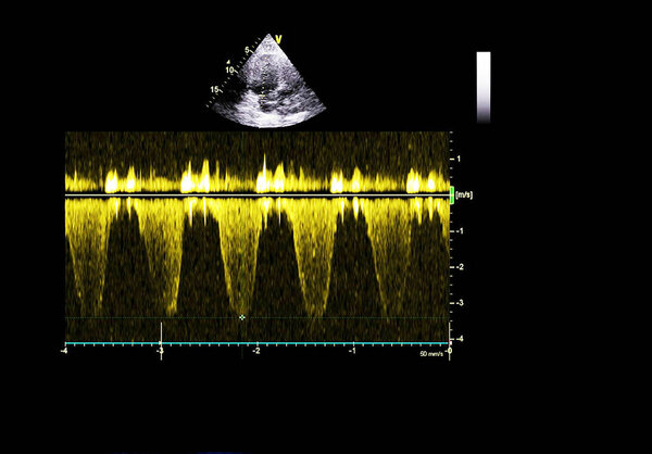 Экран эхокардиографической (ультразвуковой) машины
.