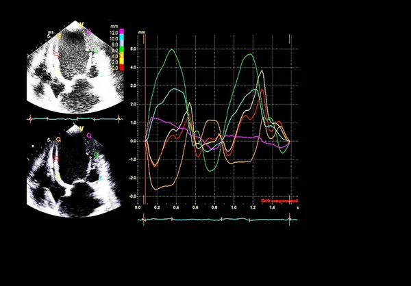 Scherm van echocardiografie (echografie) machine. — Stockfoto