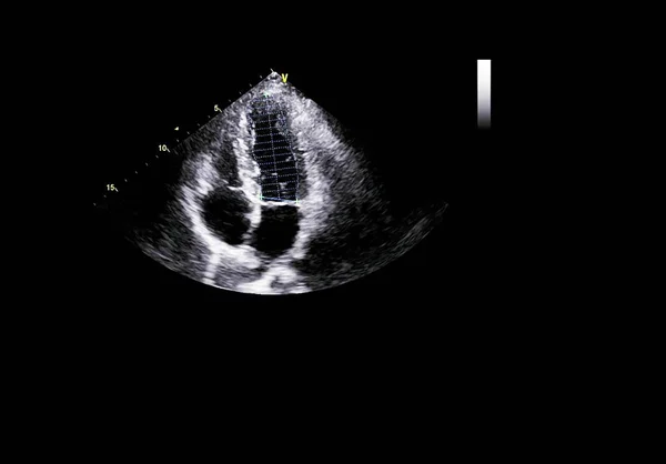 Screen of echocardiography (ultrasound) machine. — Stock Photo, Image