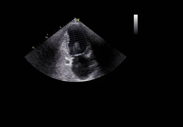 Pantalla de la máquina de ecocardiografía (ultrasonido) . — Foto de Stock